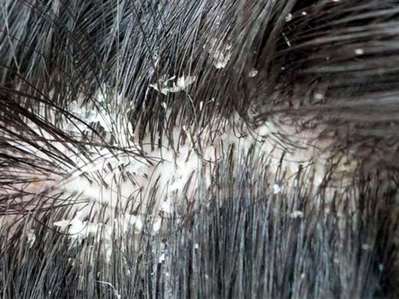 Try this natural hair pack for one time a week to get rid of dandruff full details here