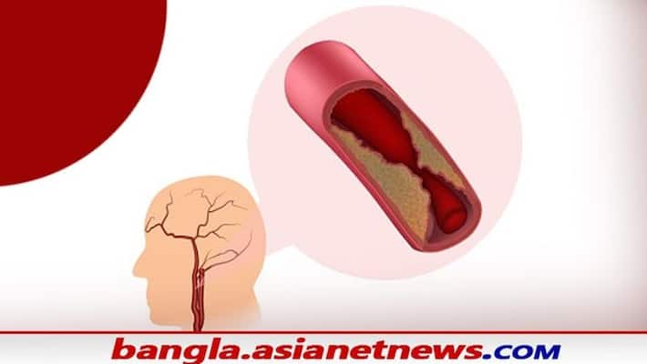 Many people are suffering from carotid artery disease- Symptoms & Treatment Many people are suffering from carotid artery disease- Symptoms & Treatment