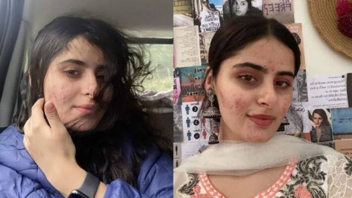 woman share bad experience on shaming for acne woman share bad experience on shaming for acne
