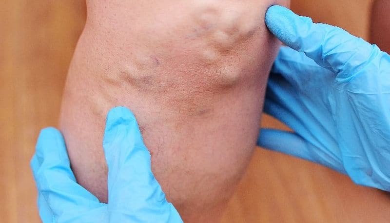 deep vein thrombosis might show evident symptoms