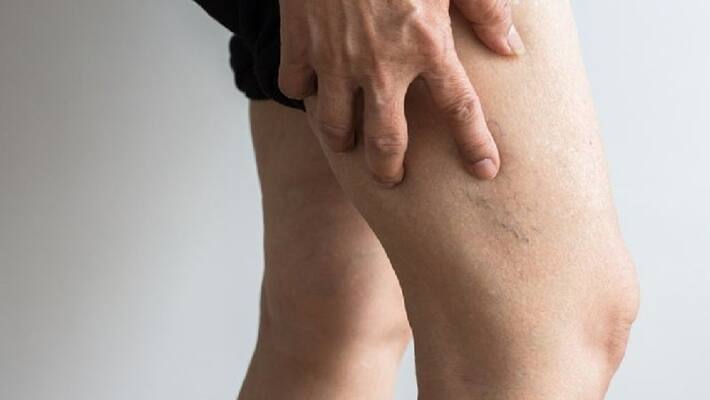 deep vein thrombosis might show evident symptoms deep vein thrombosis might show evident symptoms