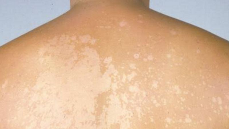 Best effective home remedies to treat white patches full details are here
