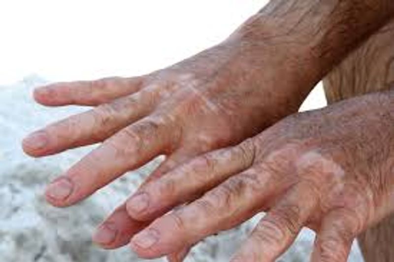 Best effective home remedies to treat white patches full details are here