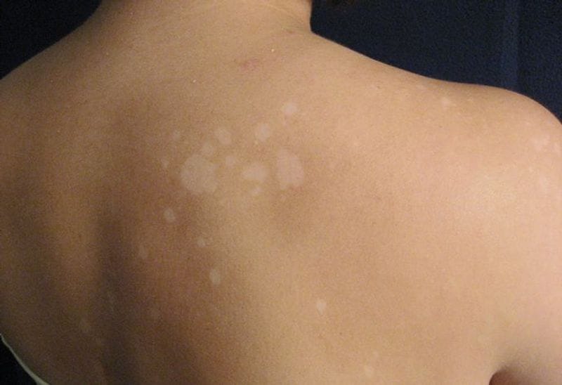 Best effective home remedies to treat white patches full details are here