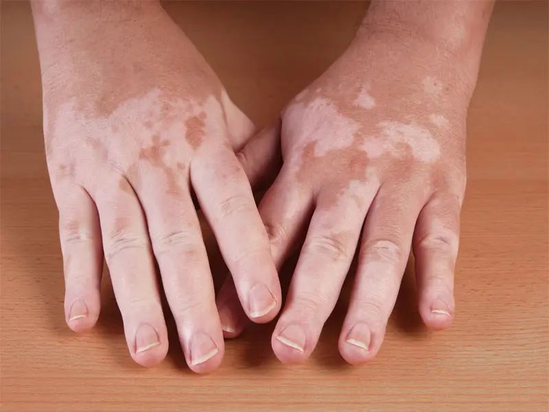 Best effective home remedies to treat white patches full details are here