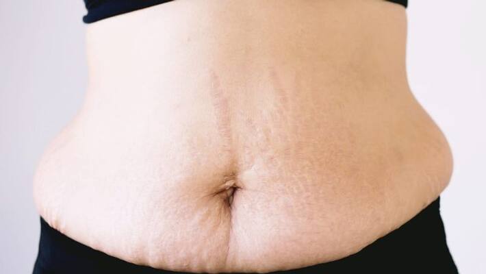 tips to get rid of stretch marks after delivery tips to get rid of stretch marks after delivery