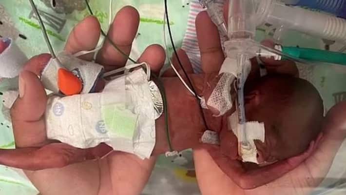 USA story of the world most premature baby in Birmingham kpn USA story of the world most premature baby in Birmingham kpn