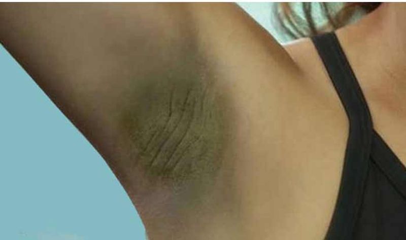 Reasons behind dark armpits full details are here