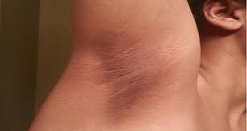 Reasons behind dark armpits full details are here