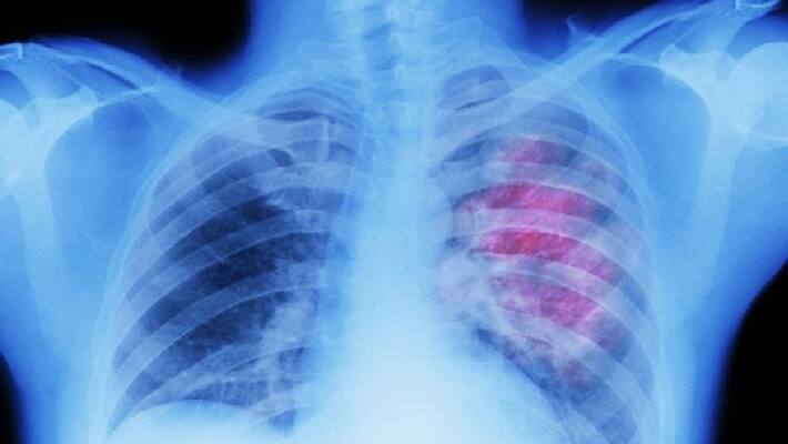 check oxygen level after covid recovery to know is the disease affected lungs check oxygen level after covid recovery to know is the disease affected lungs
