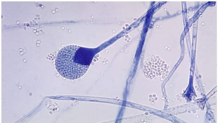 Covid diabetes link leading to black fungus experts Covid diabetes link leading to black fungus experts
