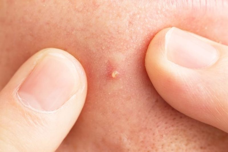 Best scrubs to remove whiteheads full details are here