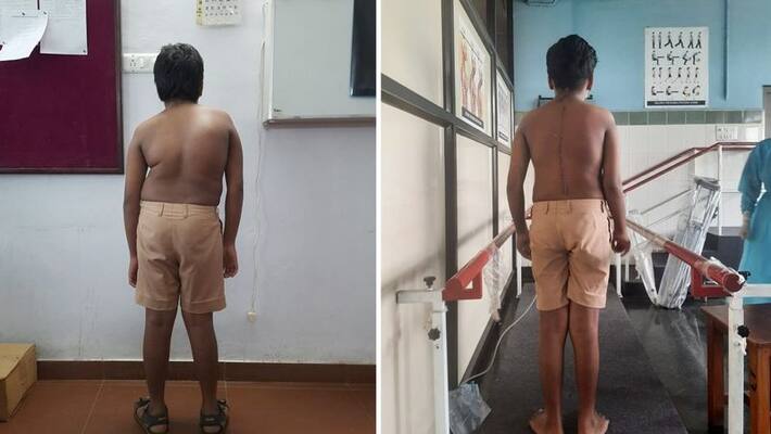 scoliosis surgery successful at thrissur govt medical college scoliosis surgery successful at thrissur govt medical college