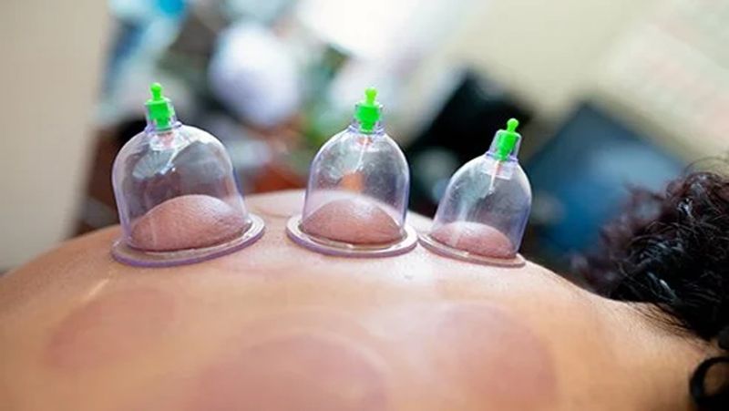 What is Cupping therapy, know its benefits, process and treatment dva