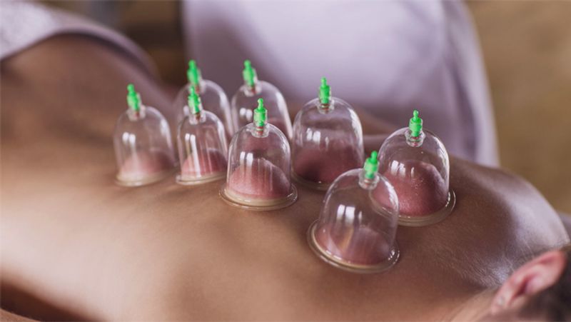 What is Cupping therapy, know its benefits, process and treatment dva