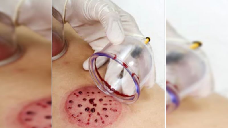 What is Cupping therapy, know its benefits, process and treatment dva