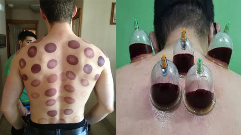 What is Cupping therapy, know its benefits, process and treatment dva