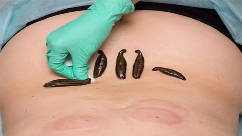 Leech Therapy: what is jonk therapy, know its benefits, advantage and disadvantage dva