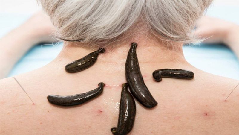 Leech Therapy: what is jonk therapy, know its benefits, advantage and disadvantage dva