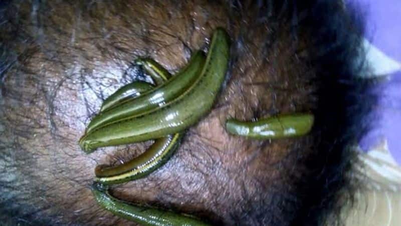 Leech Therapy: what is jonk therapy, know its benefits, advantage and disadvantage dva