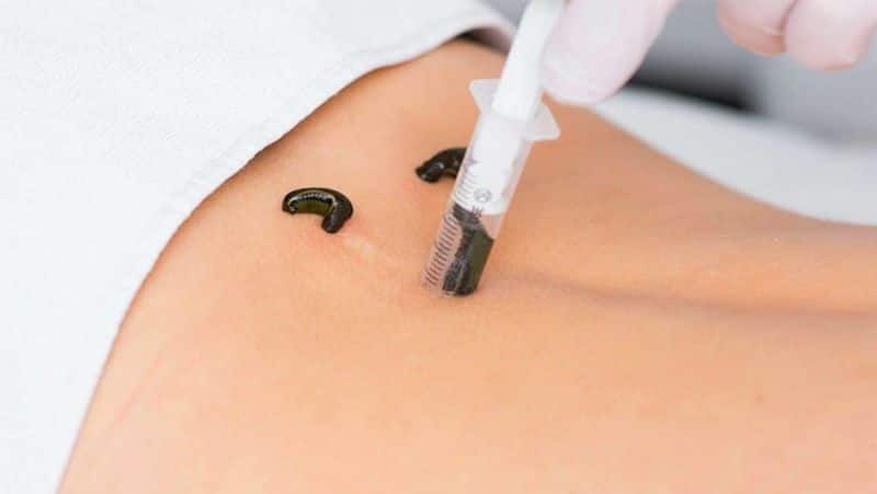 Leech Therapy: what is jonk therapy, know its benefits, advantage and disadvantage dva