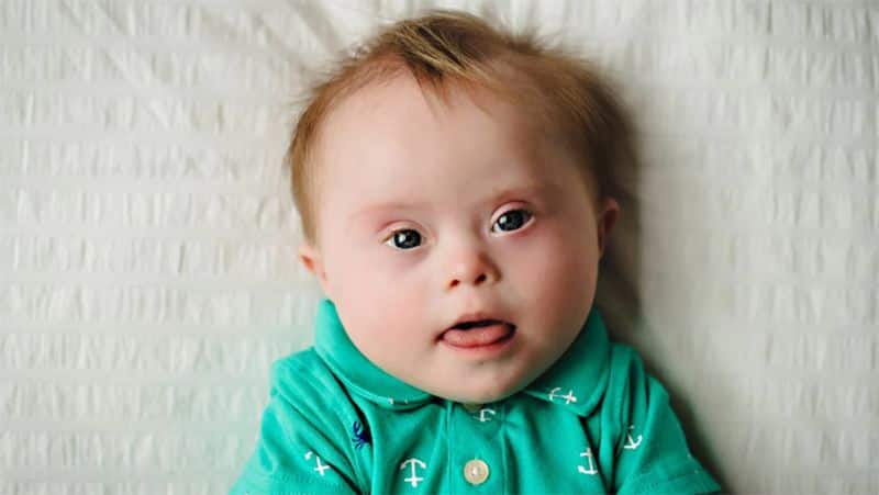 World Disability Day 2021: what is Down syndrome? know its Symptoms, causes and treatment dva