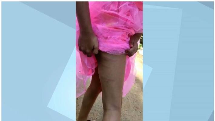 Madrasa student was brutally beaten by teacher in Nilambur Madrasa student was brutally beaten by teacher in Nilambur