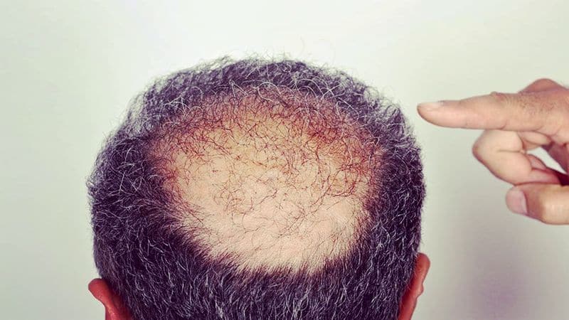 Did you know that making these mistakes can lead to baldness?