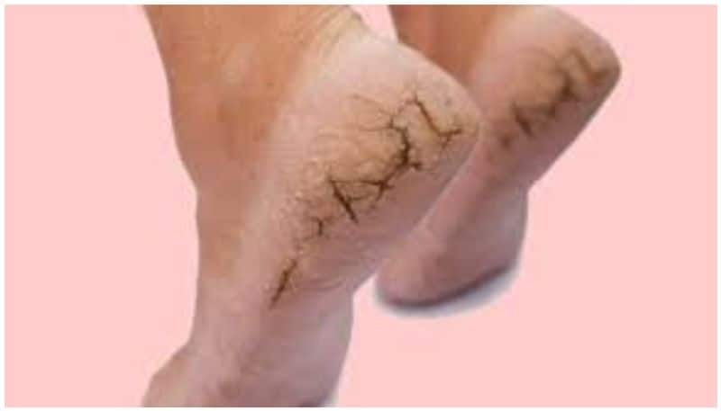 Cracked heels can be a result of digestion problems