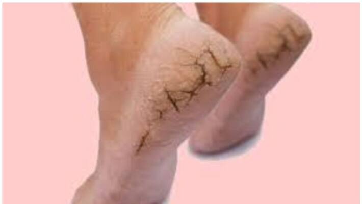 5 easy remedies for winter cracked heels 5 easy remedies for winter cracked heels