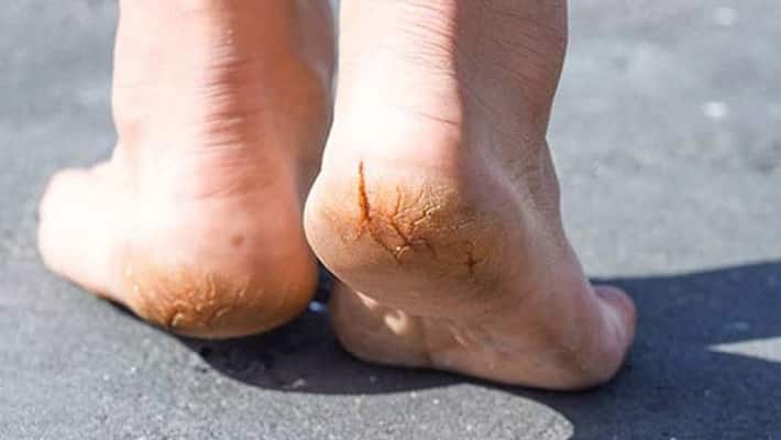 winter skin car these 4 kitchen ingredient can fix cracked heels permanently NTP winter skin car these 4 kitchen ingredient can fix cracked heels permanently NTP