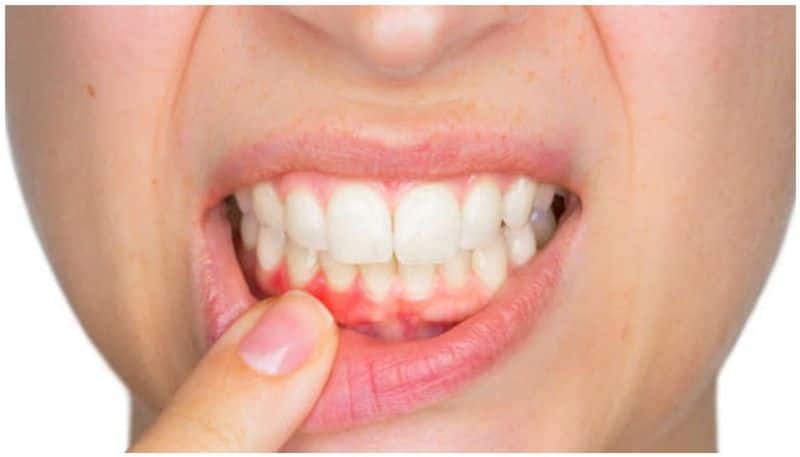 know these 5 Simple ways to keep your Bleeding or Swollen gums healthy bpsb