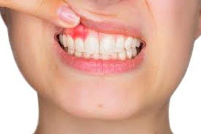 How to prevent bleeding from gums full details are here