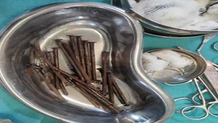Madhya Pradesh shocking news strange case 27 sharp nail found in boy stomach gwalior Madhya Pradesh shocking news strange case 27 sharp nail found in boy stomach gwalior