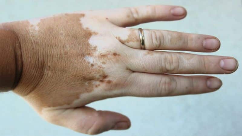 Health Tips: what is Vitiligo disease, know its myths, symptoms and treatment dva