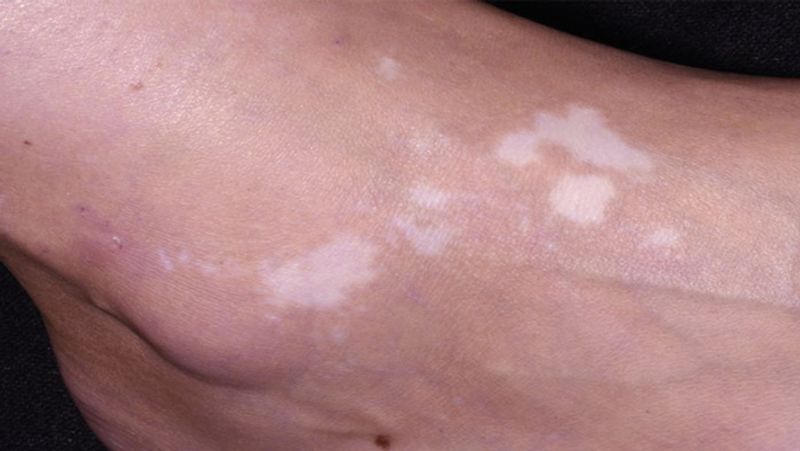 Health Tips: what is Vitiligo disease, know its myths, symptoms and treatment dva