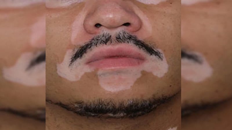 Health Tips: what is Vitiligo disease, know its myths, symptoms and treatment dva