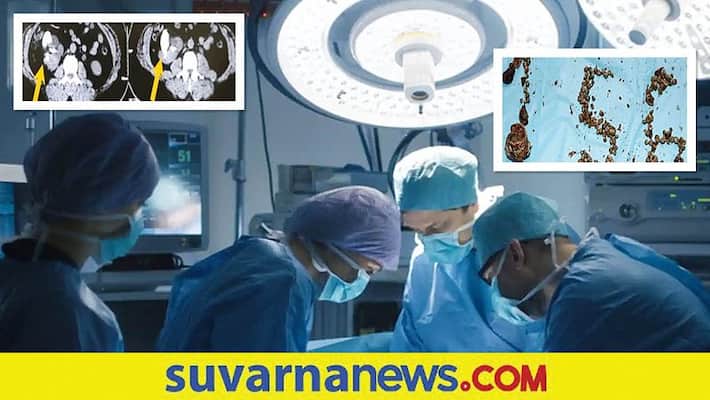 Doctors Remove 156 kidney stones from one patient in hyderabad Hospital san Doctors Remove 156 kidney stones from one patient in hyderabad Hospital san