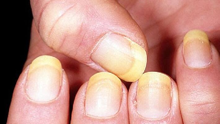 color changes in nail may be the sign of some health problems color changes in nail may be the sign of some health problems