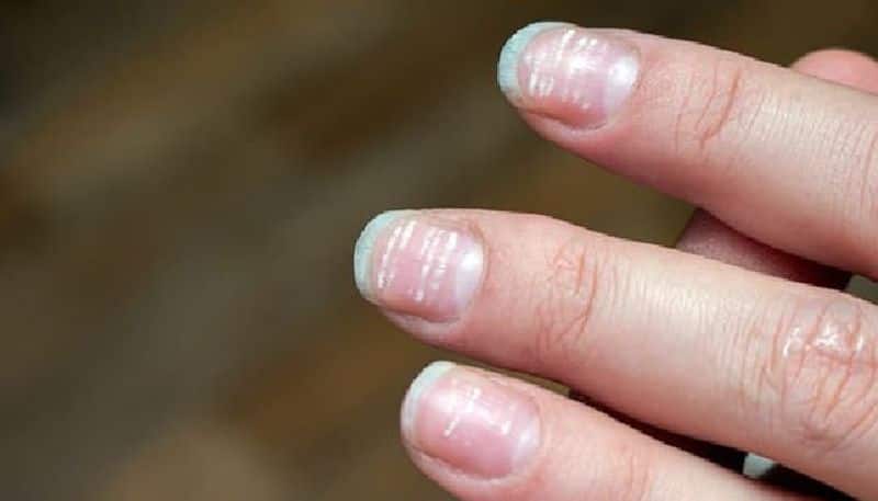 nail health can indicate many diseases