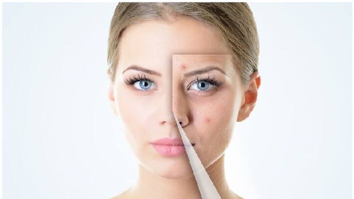 easy home remedies for pimples easy home remedies for pimples