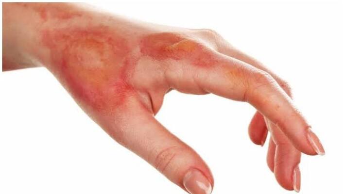 Karnataka Woman's hand burnt as husband forces her take a fidelity test-dnm Karnataka Woman's hand burnt as husband forces her take a fidelity test-dnm