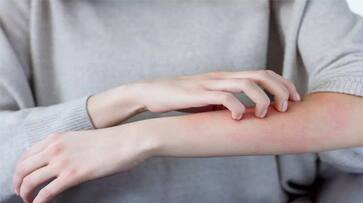 skeeter syndrome symptoms treatment and prevention tips-rse- skeeter syndrome symptoms treatment and prevention tips-rse-