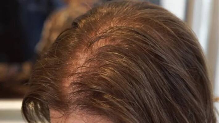 five hair care tips to treat hair thinning five hair care tips to treat hair thinning