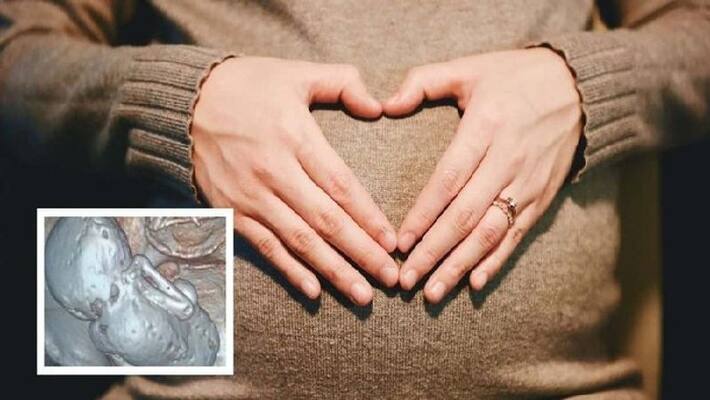 Mummified stone baby found in 73 years old lade she carry the baby last 35 years in belly Mummified stone baby found in 73 years old lade she carry the baby last 35 years in belly