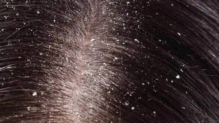 Suffering from dandruff problem use yogurt and lemon to avoid it BDD Suffering from dandruff problem use yogurt and lemon to avoid it BDD