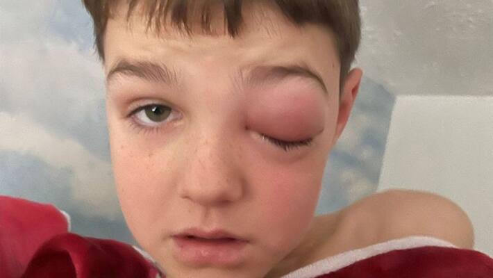 Bristol 9-year-old child eye badly affected due to covid infection kpn Bristol 9-year-old child eye badly affected due to covid infection kpn