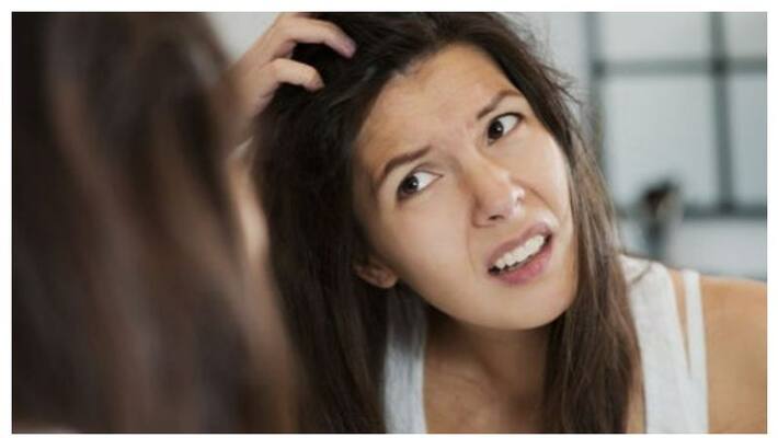 Dandruff problem home remedy tips Dandruff problem home remedy tips