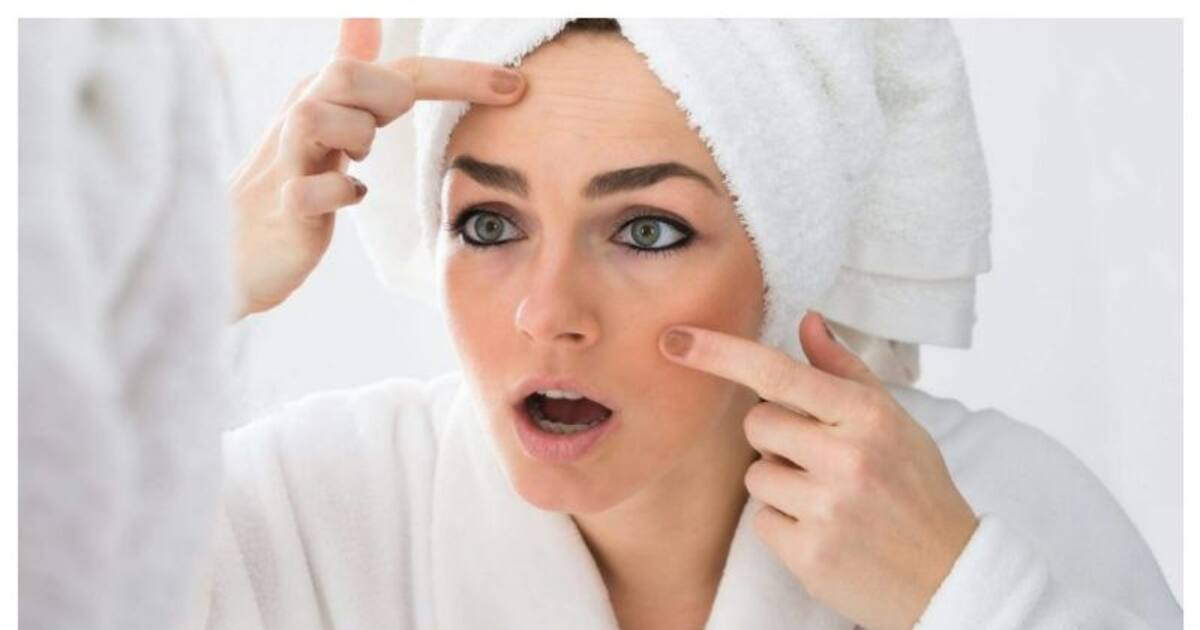 முகத்தை வெளியே காட்ட சங்கடமா? முகப்பருவை அழிக்க உதவும் எளிய 3 டிப்ஸ் இருக்கு..