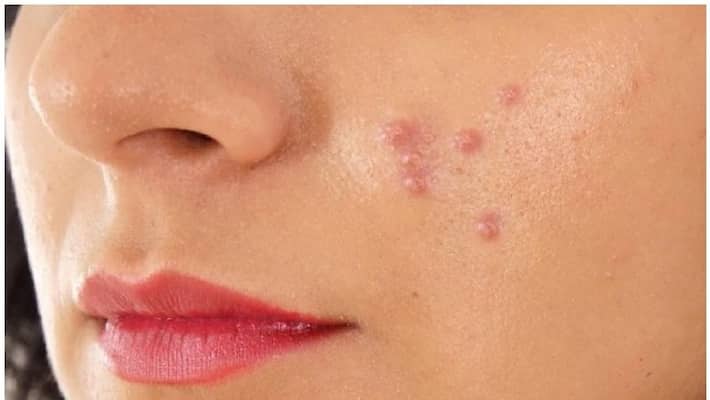 What To Do To Clear Pimple Scars: Here Are Simple Tips! What To Do To Clear Pimple Scars: Here Are Simple Tips!
